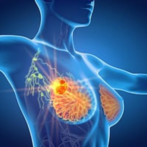 AI Spotting Hidden Breast Cancers Missed by Standard Screens